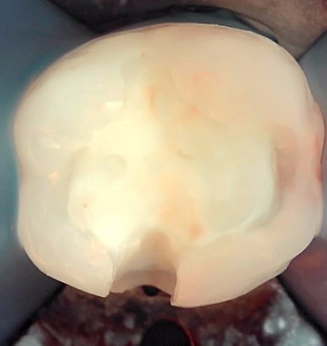 인레이치료 하방 2차 충치 레진 빌드업 사례 관련 이미지 14