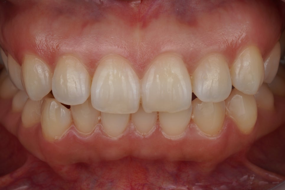 앞니 살짝 깨짐, 치아 성형으로 해결한 교대역 치과 관련 이미지 1