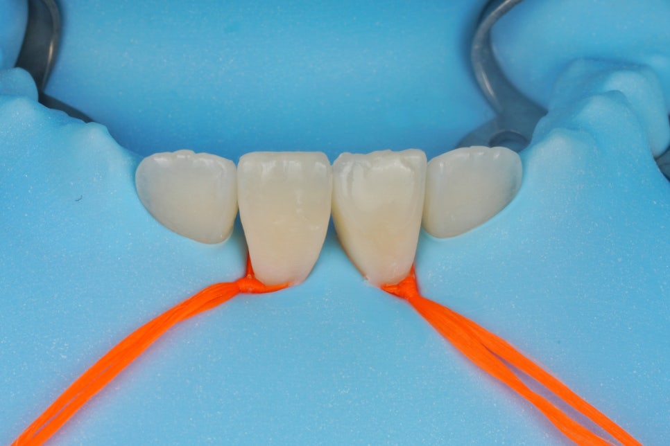 앞니 벌어짐 레진 당일 치료, 앞니 레진 잘하는 서초동 치과 관련 이미지 8