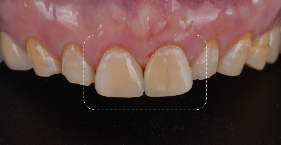 신논현역치과 심하게 마모된 60대 남성 앞니 크라운 치료 관련 이미지 13