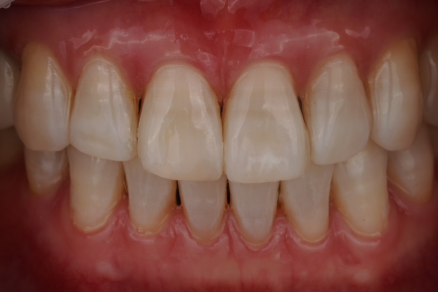 무삭제 라미네이트 잘하는 치과, 중요한 건 치아의 &lsquo;분리감&rsquo; 관련 이미지 2