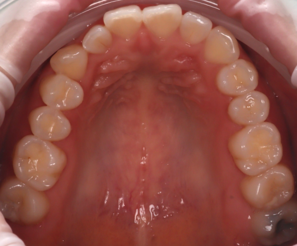 Jamnwon-dong Dental Clinic: Don’t Grind Down Your Teeth—Get Resin Build-up Instead image 2