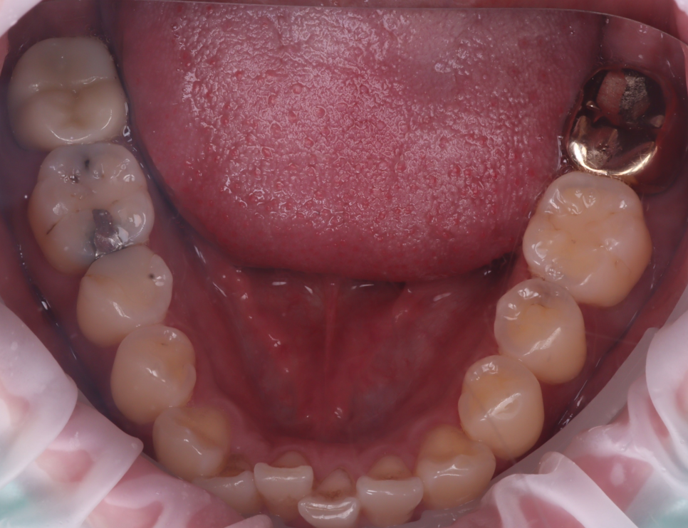 Do Cavities Between Teeth at Sinsa Station Dental Clinic Have to Be Treated with an Inlay? Resin Is Also an Option image 6