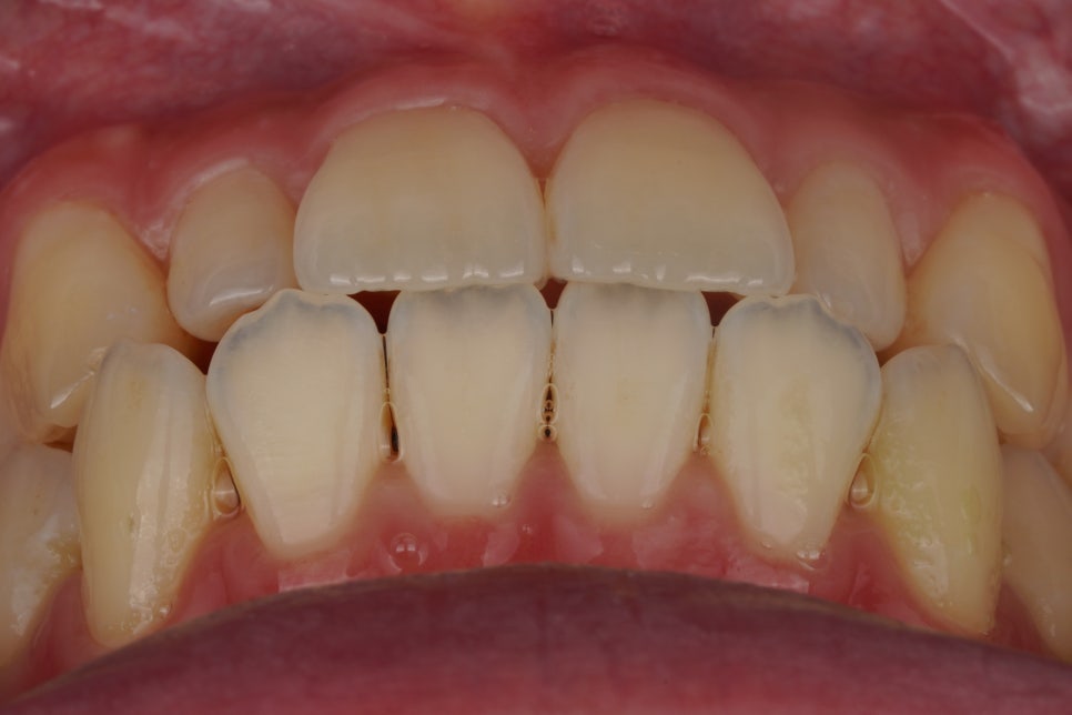 왜소치 레진, 갤럭시네이트 레진비니어로 당일 치료완료 (서초동 치과) 관련 이미지 2