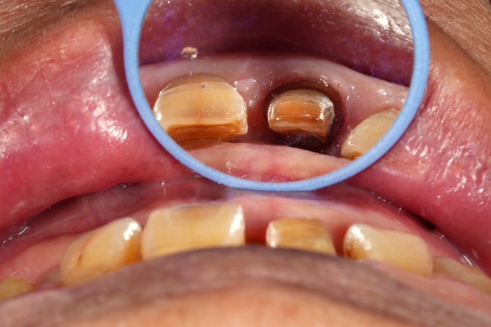 60년 전 신문배달할 때 다쳐서 씌운 앞니 크라운 변색, 지르코니아 재치료 관련 이미지 4