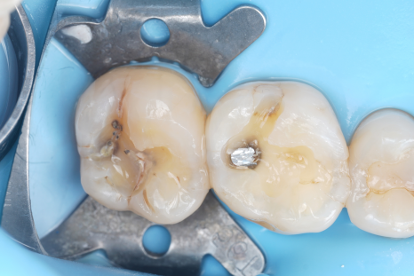 치과보존과 치아를 덜 깎는 치료를 지향하는 이유 관련 이미지 13