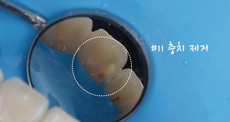 교대역치과 타치과 신경치료, 크라운 진단받았으나 레진으로 치료 관련 이미지 6