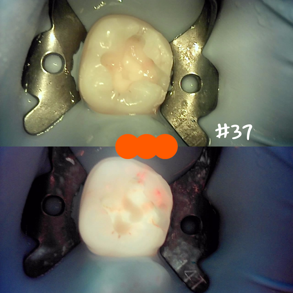교대역치과 타치과 신경치료, 크라운 진단받았으나 레진으로 치료 관련 이미지 17