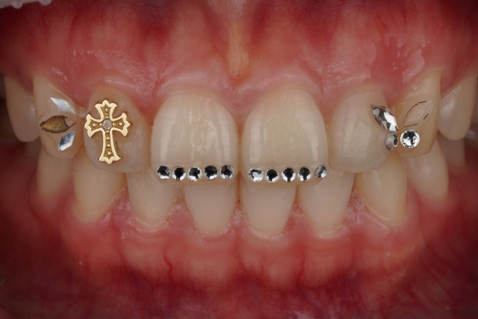 요즘 투스젬 맛집, 근데 이제 제거 맛집인- 투스젬 제거킹 재좋치 관련 이미지 5