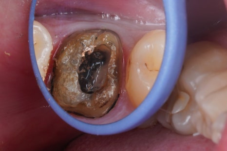 신경치료 후 크라운 씌운 치아 통증, 재신경치료 및 지르코니아 크라운 재치료 관련 이미지 6