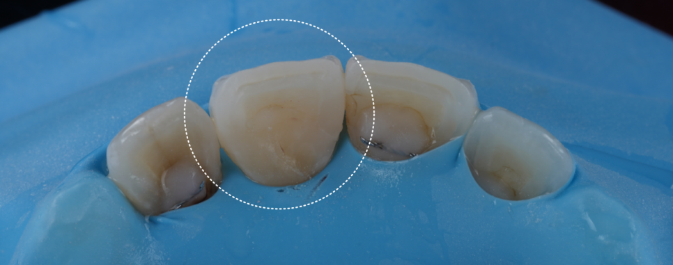 고속터미널역치과 레진치료 처음부터 잘 받아야 하는 이유 관련 이미지 9