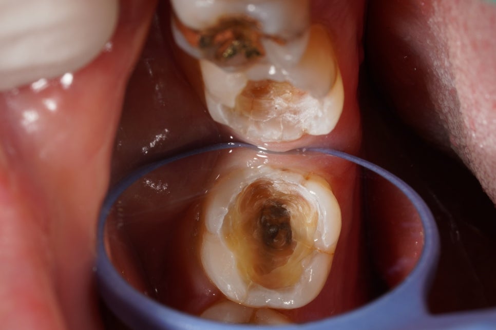 교대역 어금니 크랙 깨짐으로 씹을때 통증, 발치 피하고 신경치료로 유지한 케이스 관련 이미지 3