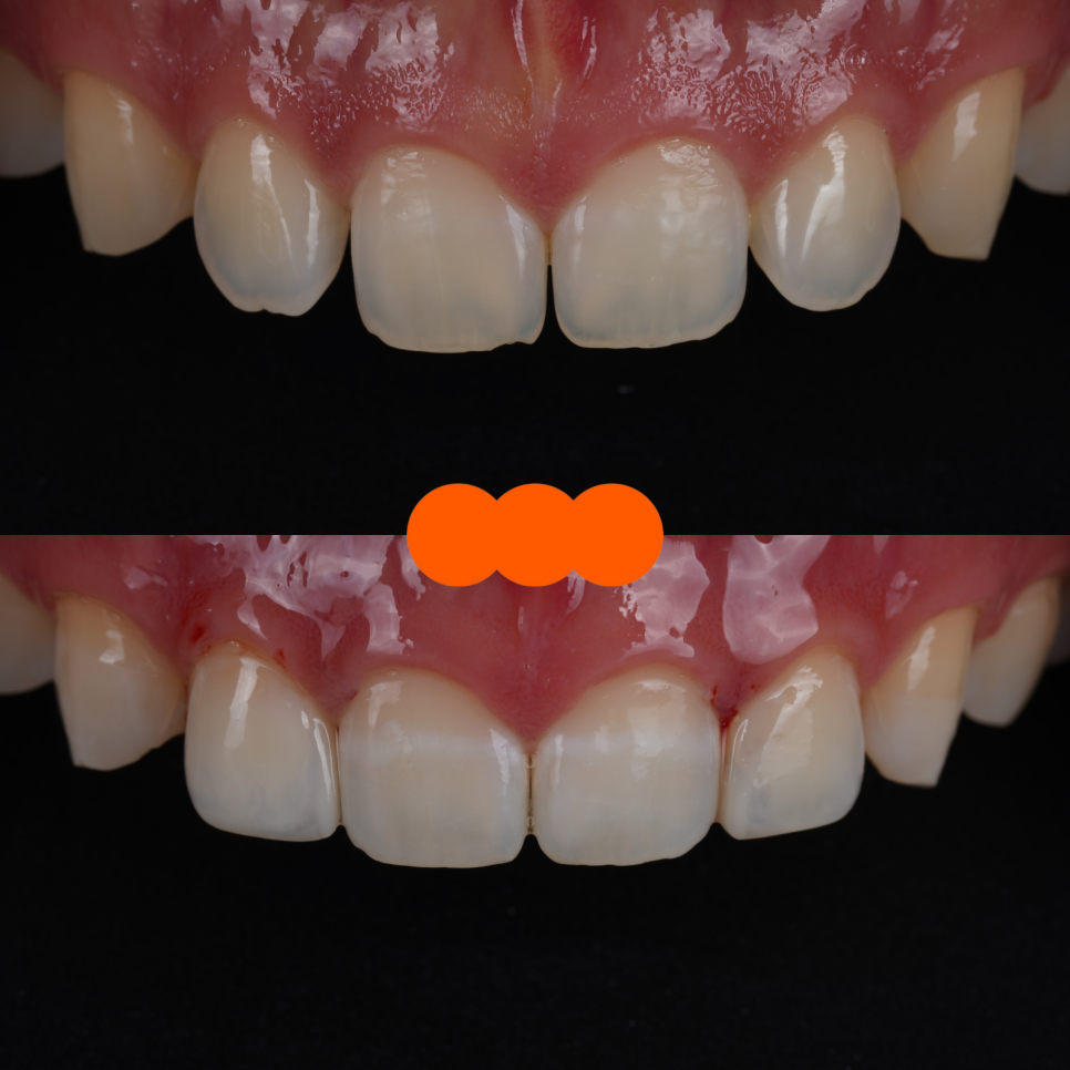 Apgujeong Dental Clinic: 3 Things Needed for Successful Resin Treatment of Peg Laterals image 12