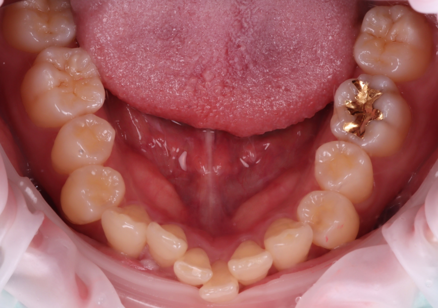 왜소치 레진으로 삭제 없이 예쁘게 관련 이미지 4