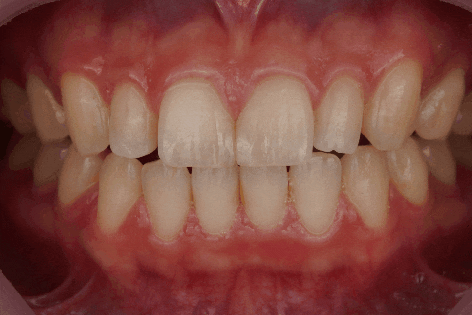 서초/강남 왜소치 레진 비니어, 당일 치료해주는 치과 Direct Composite Veneer in Korea 관련 이미지 1