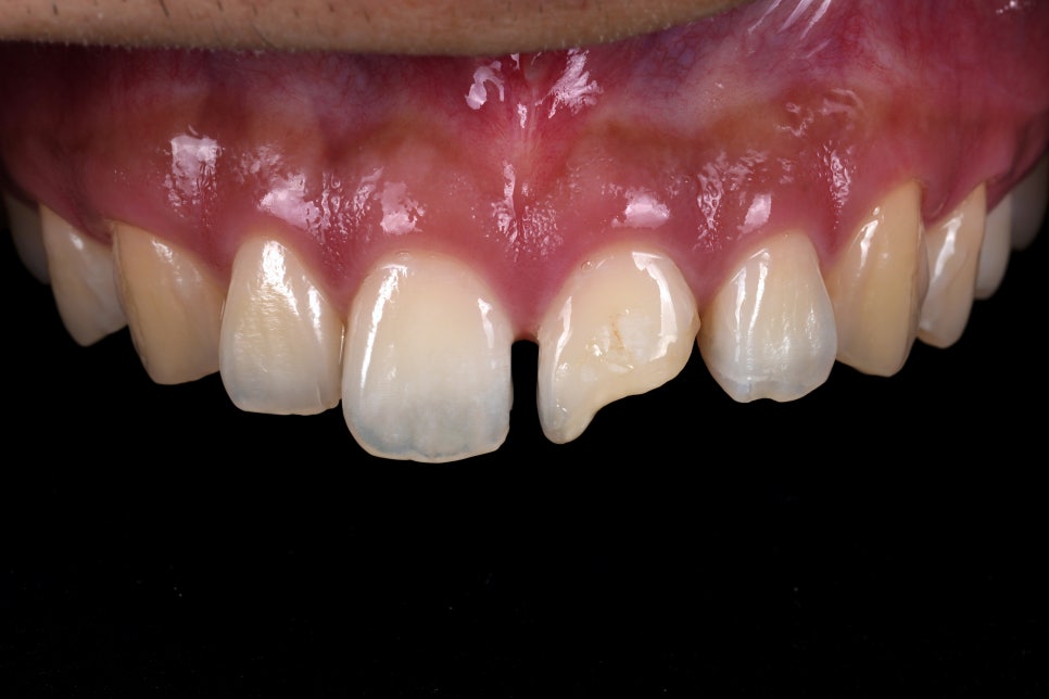 앞니 부러짐 레진, 크리스마스 이브날 앞니 복원 관련 이미지 2