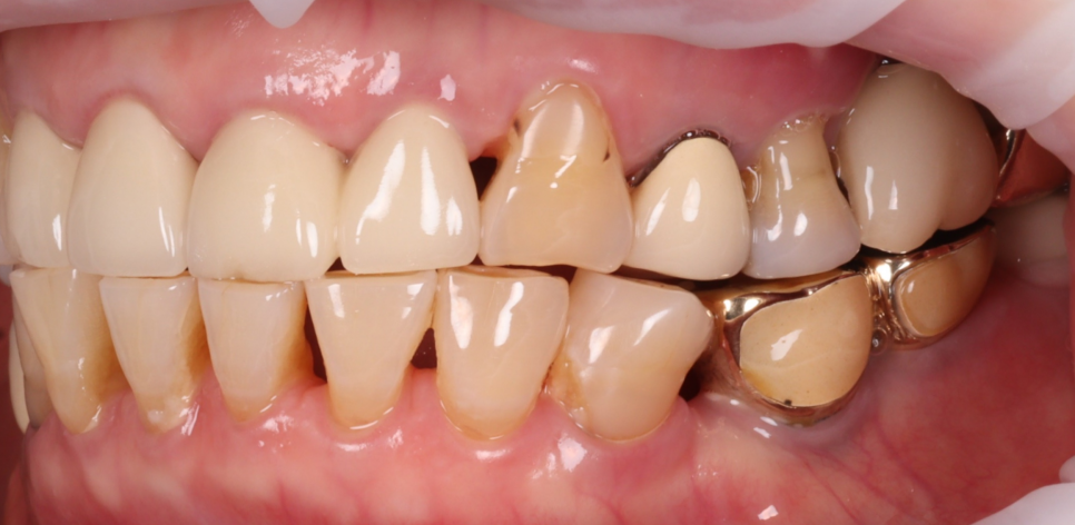 반포치과 70대 앞니 벌어짐 레진 당일 치료 케이스 관련 이미지 3