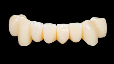 앞니 크라운 브릿지 재치료 시 이럴 땐 따로 제작해야 돼요 관련 이미지 3