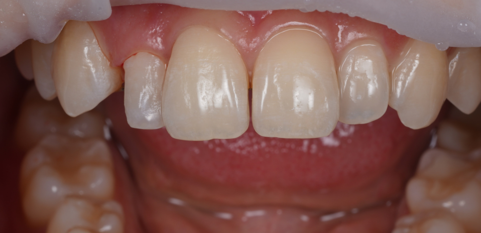 왜소치레진 20년 전에 했던 치아 재치료 후 반대쪽까지 관련 이미지 11