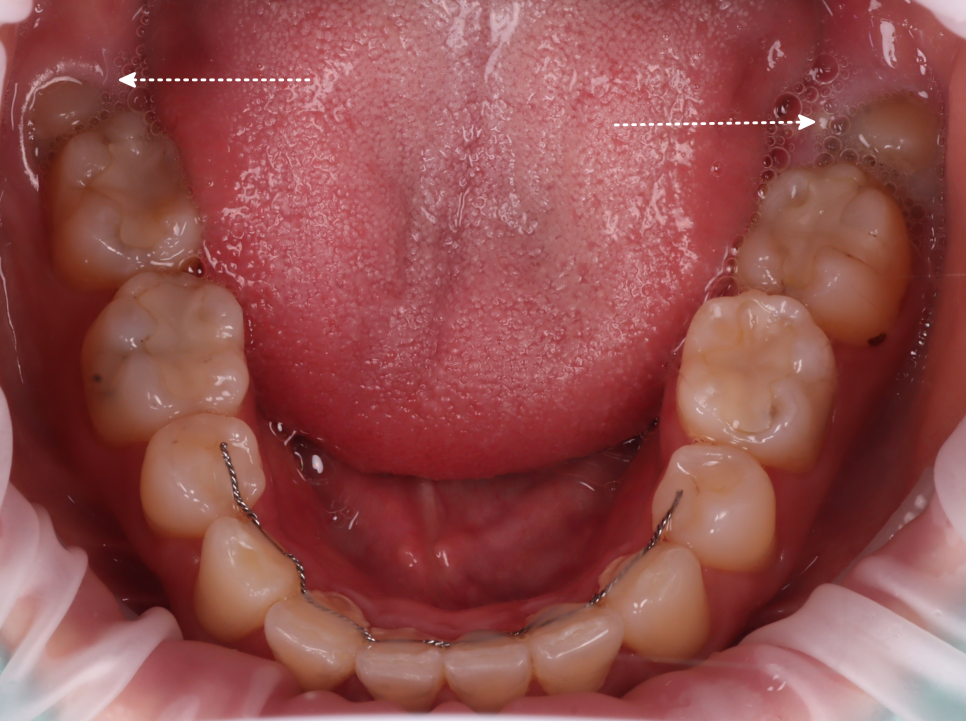 사랑니발치 매복 돼도 이렇게 빼면 안전해요 관련 이미지 4
