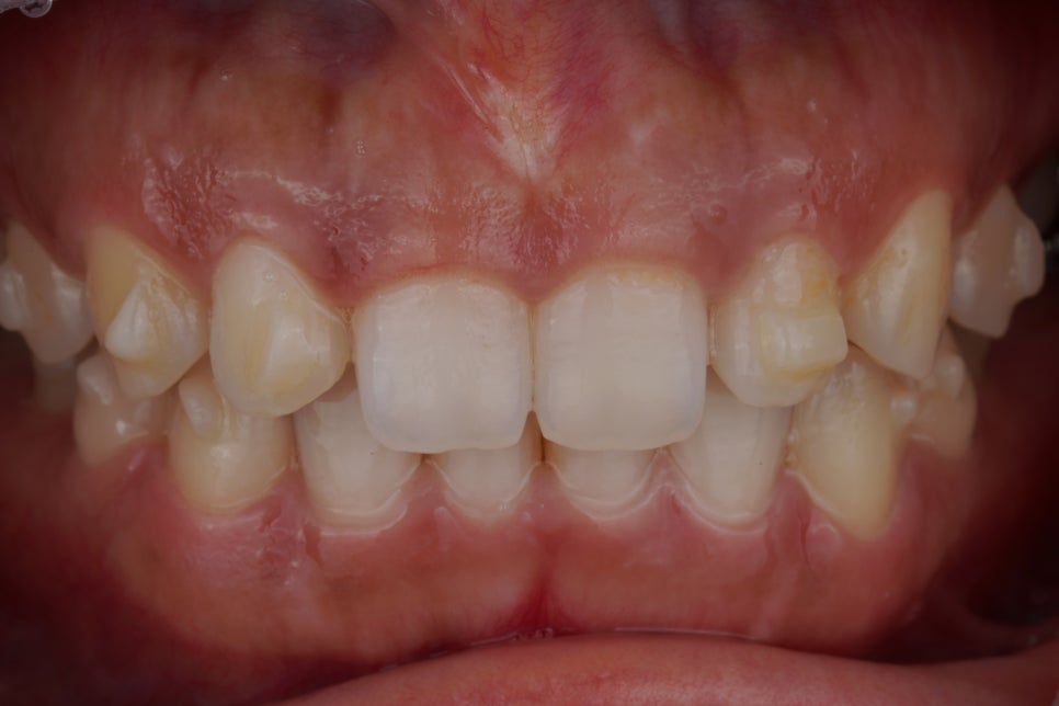 앞니 치료, 왜소치 레진은 교대역 치과에서 당일 치료받으세요 관련 이미지 1