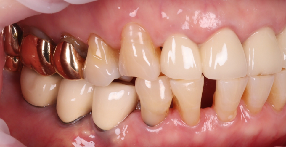 반포치과 70대 앞니 벌어짐 레진 당일 치료 케이스 관련 이미지 4