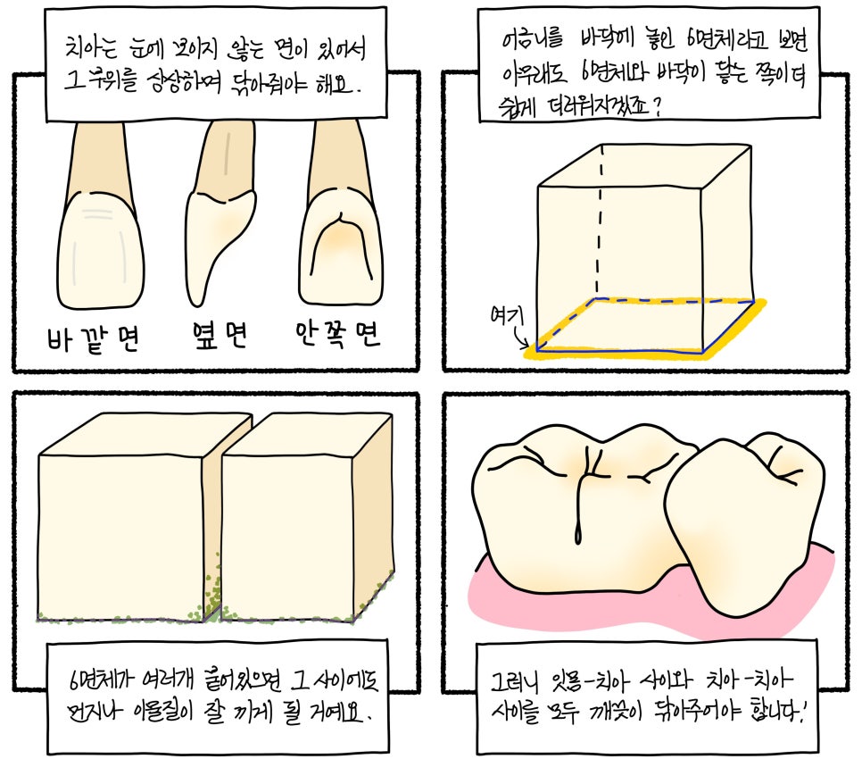 앞니 사이 충치, 앞니 레진 변색 재치료 이야기 관련 이미지 4