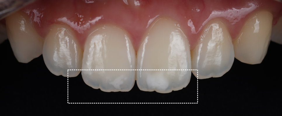 강남치과추천 앞니 하얀 반점 당일 심미 레진으로 해결 관련 이미지 4
