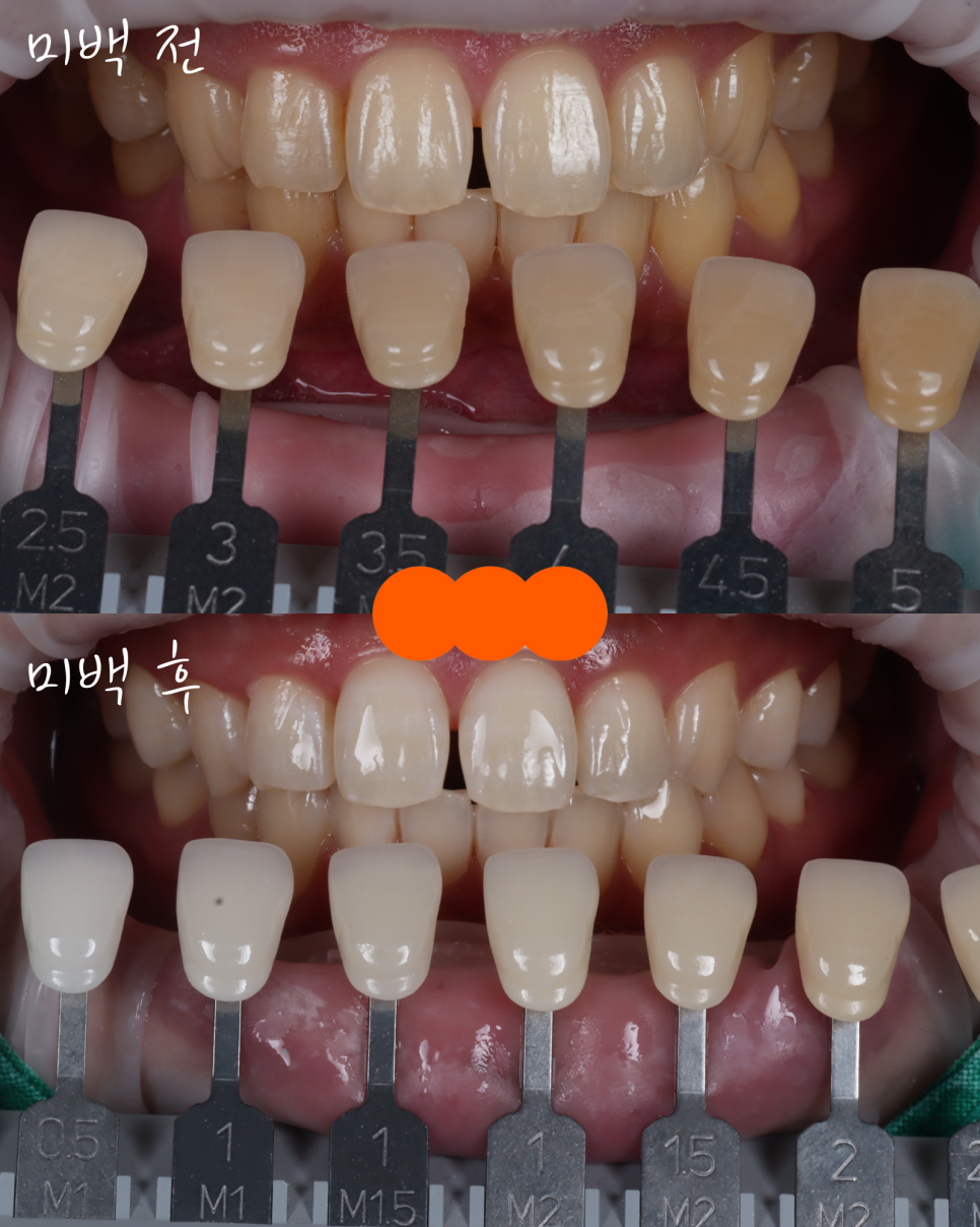 방배동치과 누렇고 벌어진 치아 미백과 레진 치료 관련 이미지 12