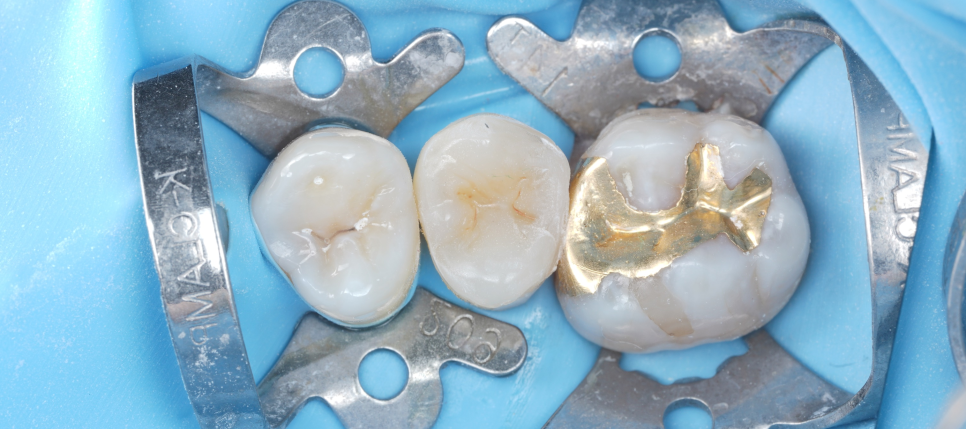 신경치료 후 크라운 안 하고 레진으로 할 수 있어요 관련 이미지 9