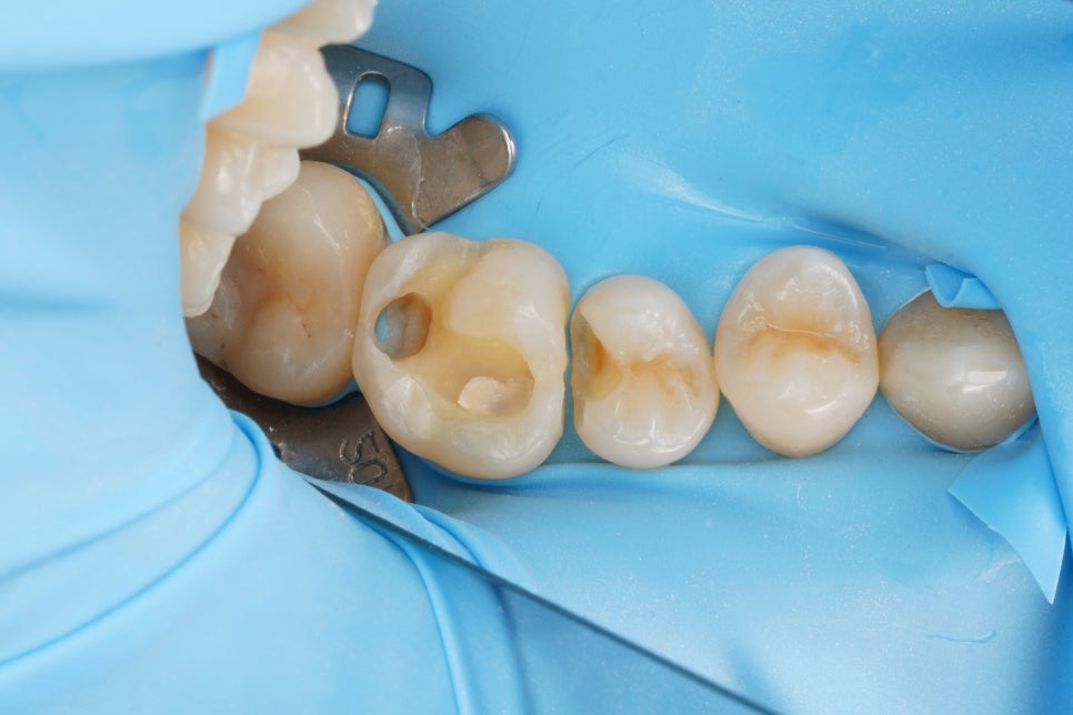 교대역 충치 치과, 신경치료 진단은 보수적으로 접근합니다. 관련 이미지 2