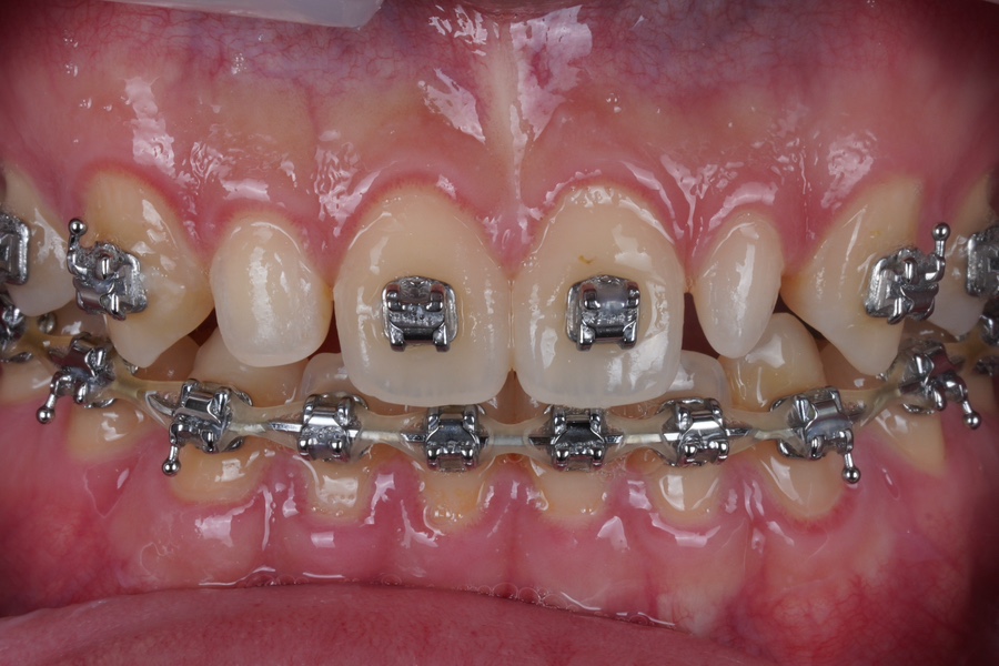 왜소치 레진 비니어, 교정 마무리 할 때 오시면 참 좋습니다. 관련 이미지 2