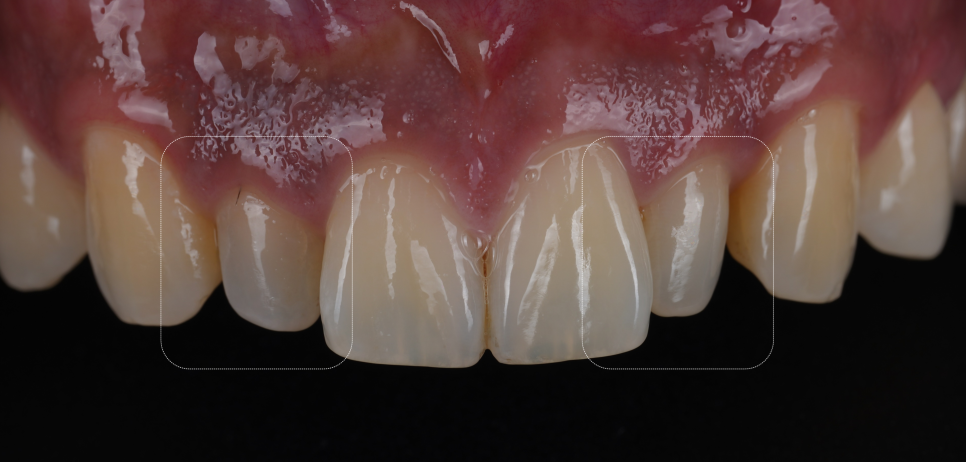 강남역치과 왜소치 레진 비니어로 삭제없이 가지런히 관련 이미지 1