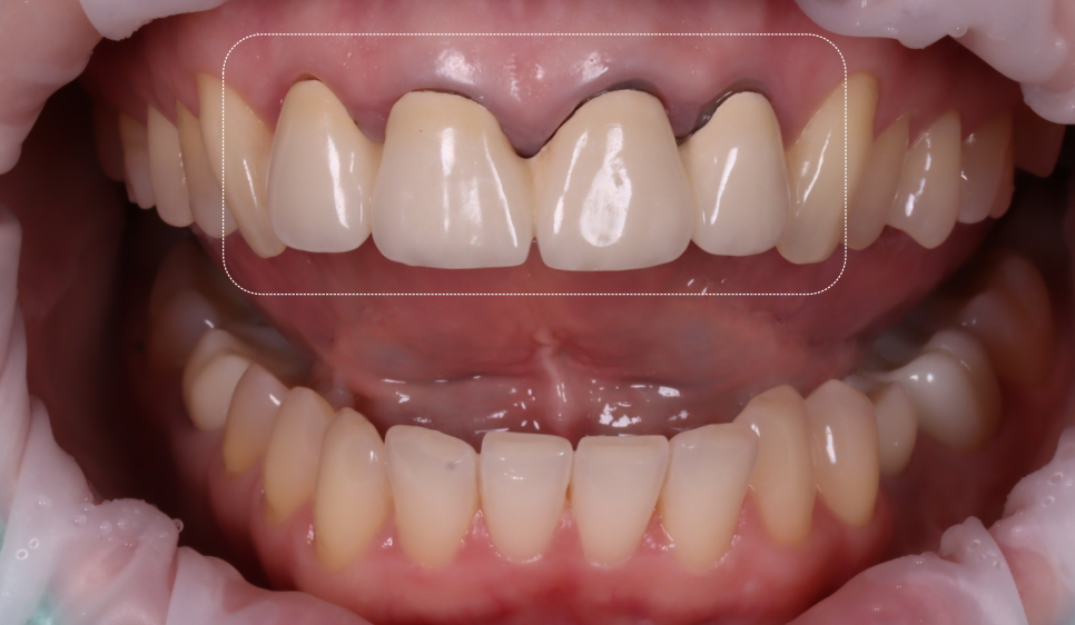 신논현치과 외국인 까만 앞니 크라운 교체 사례 관련 이미지 3