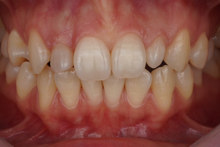 왜소치 레진 라미네이트, 당일 치료 완료! Direct composite veneer하는 서초동 치과 관련 이미지 1