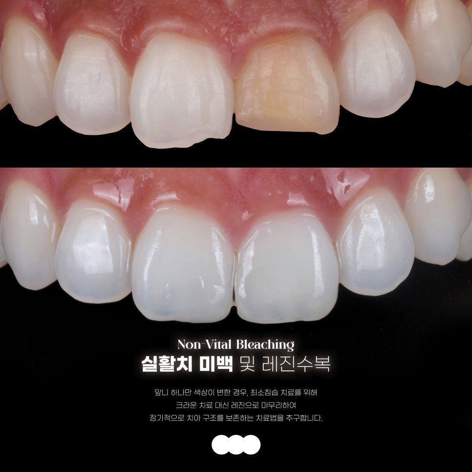 앞니 깨짐, 레진으로 1시간만에 감쪽같이 치료해드렸습니다. 관련 이미지 3