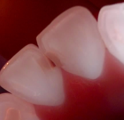 교대역 치과 보철 아래 2차 충치를 다시 레진으로 관련 이미지 6