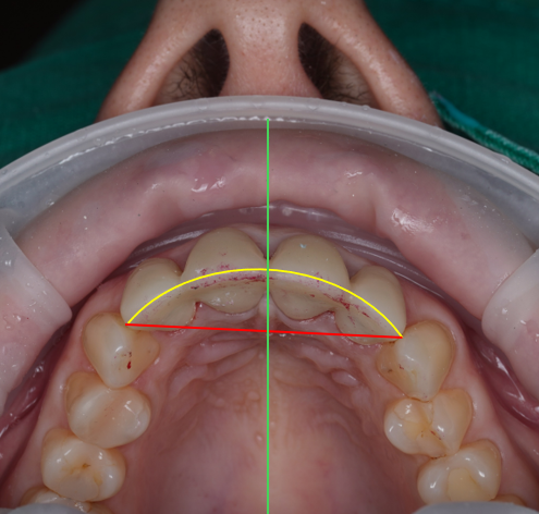 신논현치과 외국인 까만 앞니 크라운 교체 사례 관련 이미지 21