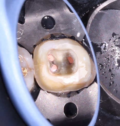 교대역 어금니 크랙 깨짐으로 씹을때 통증, 발치 피하고 신경치료로 유지한 케이스 관련 이미지 6