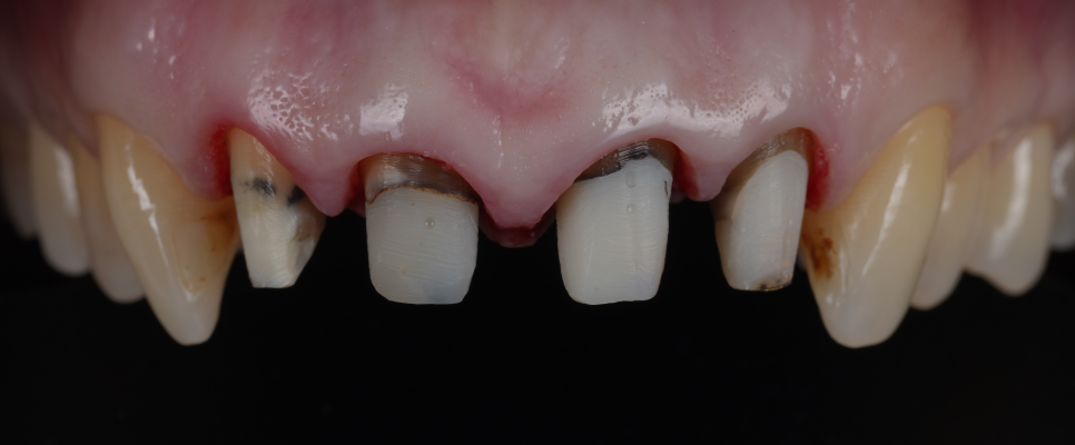 신논현치과 외국인 까만 앞니 크라운 교체 사례 관련 이미지 19