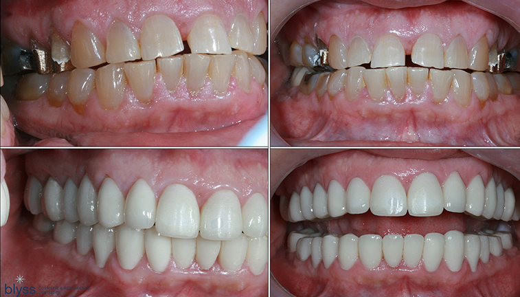 이갈이 장치 보톡스랑 함께 하면 훨씬 좋은 이유 관련 이미지 12