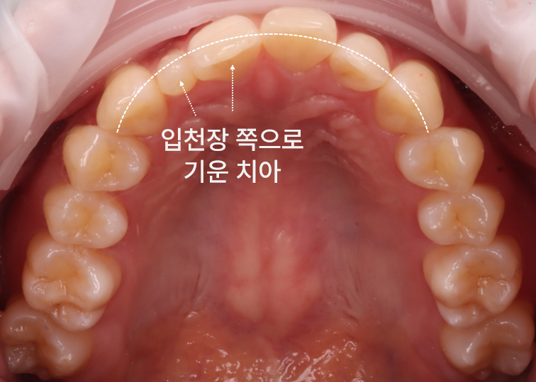 왜소치 레진으로 삭제 없이 예쁘게 관련 이미지 6