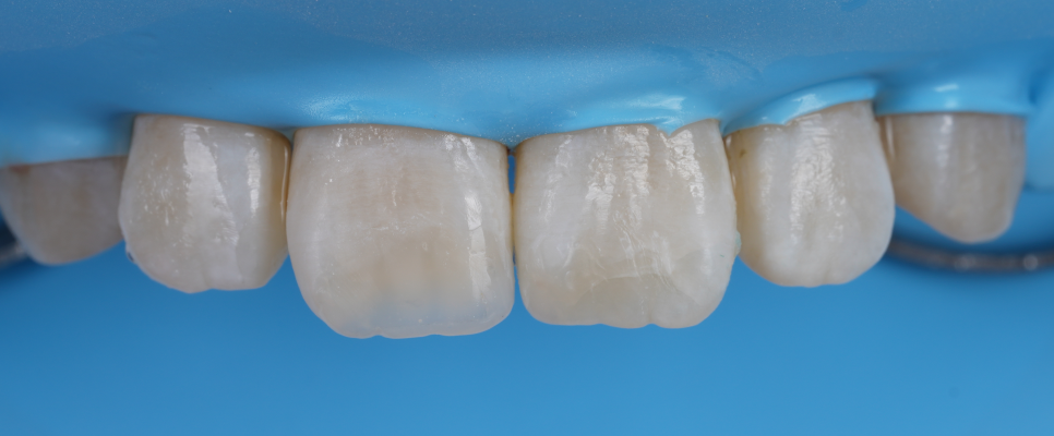 반포동치과 앞니 깨짐 레진 삭제 없이 당일에 치료 끝 관련 이미지 9