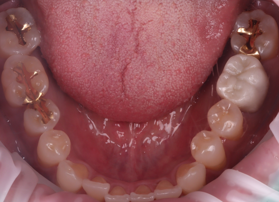 교대치과 신경치료 후 크라운 안 하고 오버레이로 보존 관련 이미지 5