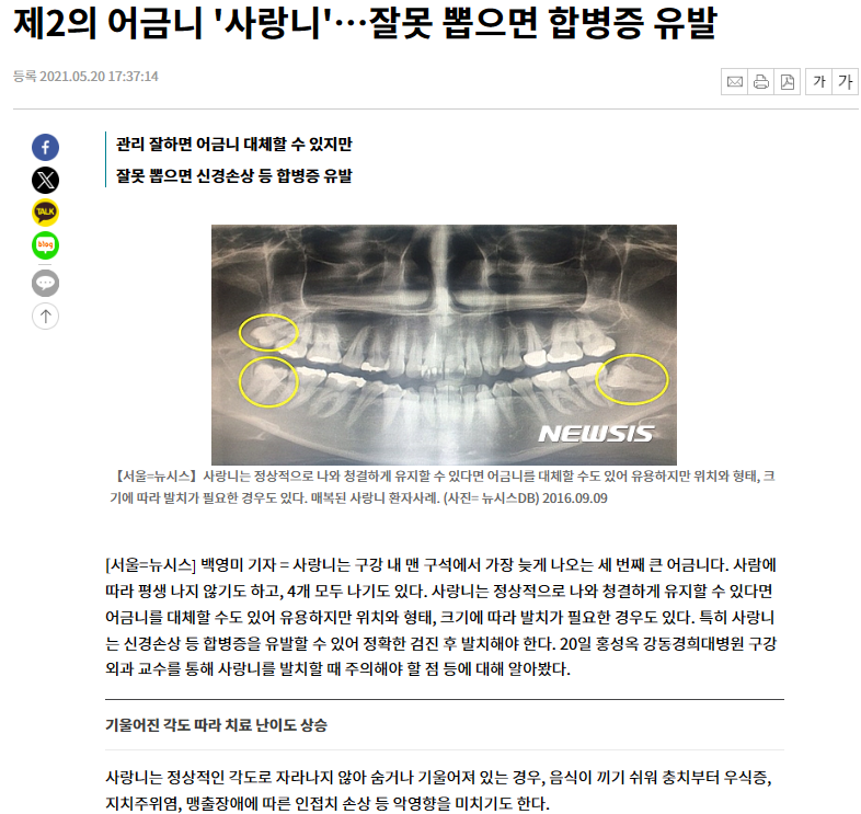 사랑니발치 매복 돼도 이렇게 빼면 안전해요 관련 이미지 1