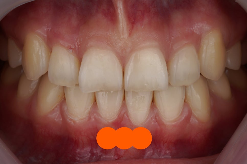 요즘 투스젬 맛집, 근데 이제 제거 맛집인- 투스젬 제거킹 재좋치 관련 이미지 4