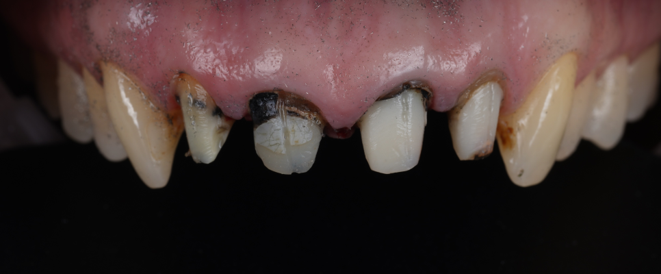 앞니 크라운 검은 선 단순한 보철 문제가 아닐 수도 있습니다 관련 이미지 6