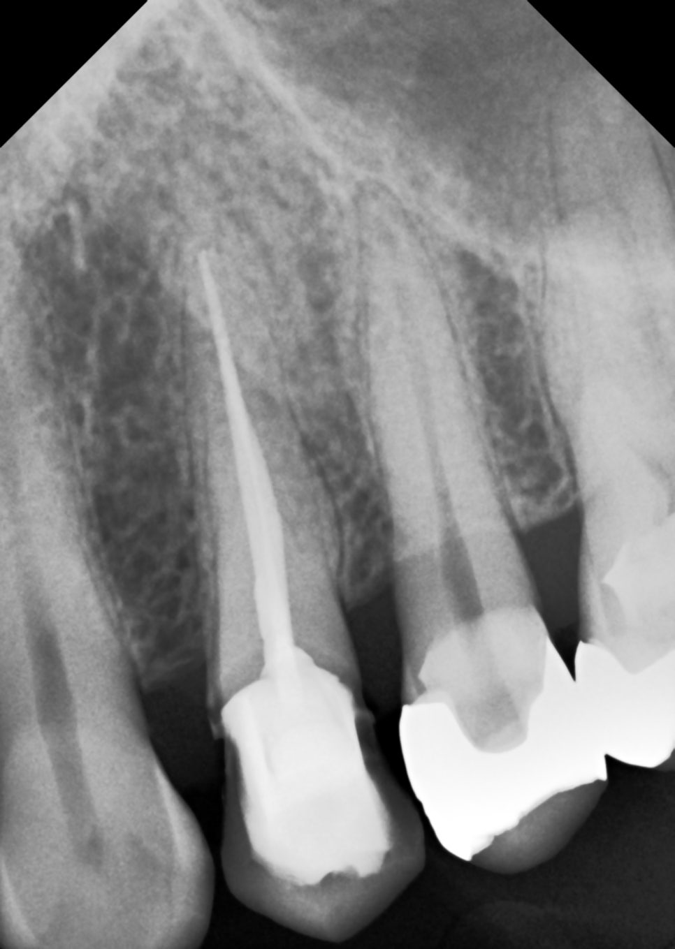 교대치과 신경치료 후 크라운 안 하고 오버레이로 보존 관련 이미지 12