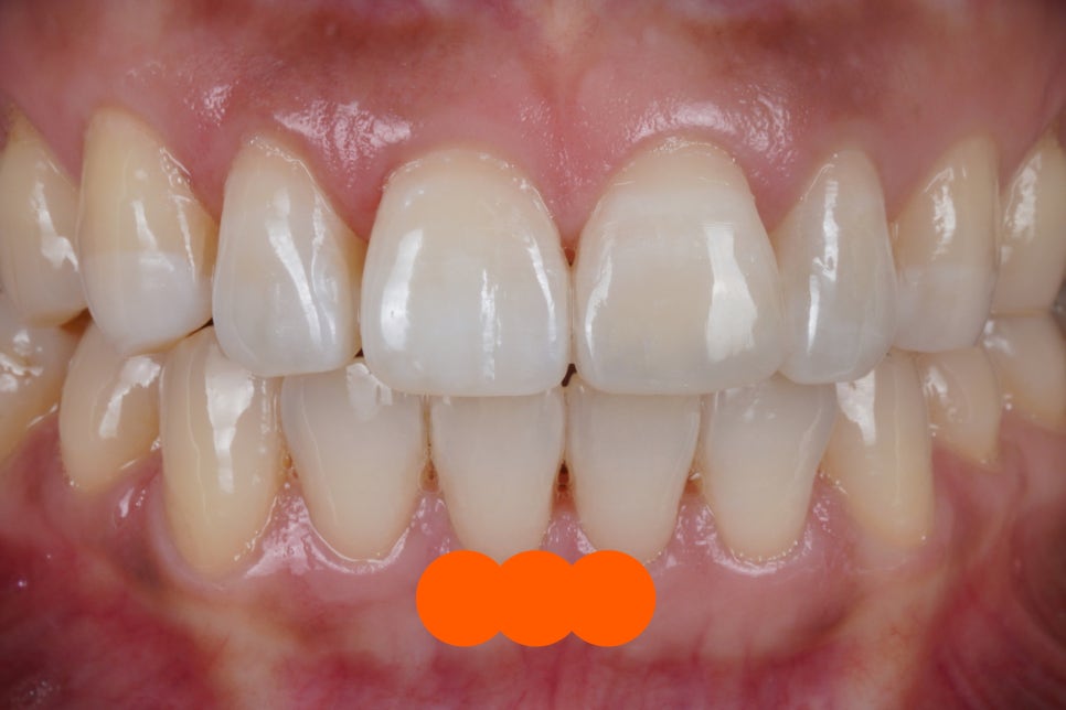 서울 앞니 레진으로 40분 안에 자연스럽게 복원한 케이스 관련 이미지 2