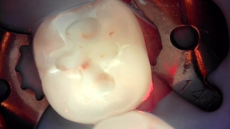 서초동치과 치아 삭제 원하지 않는다면 오버레이 하세요 관련 이미지 5